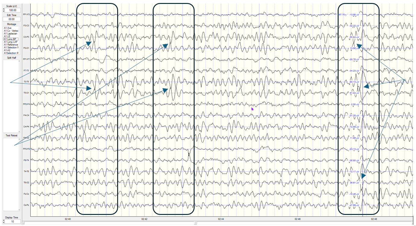 Longitudinal bipolar montage with phase reversals marked